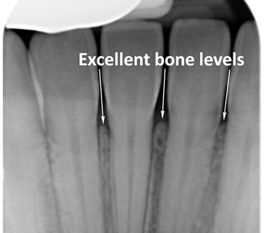 Healthy bone around lower front teeth