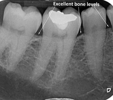 Healthy bone around lower back teeth