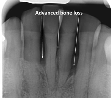 Advanced bone loss around lower front teeth