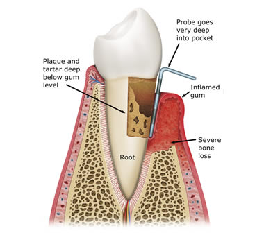 Diagram of advanced periodontitis