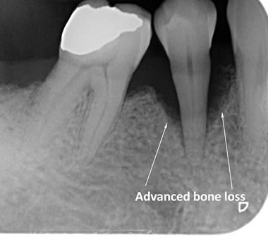 Advanced bone loss around lower back tooth