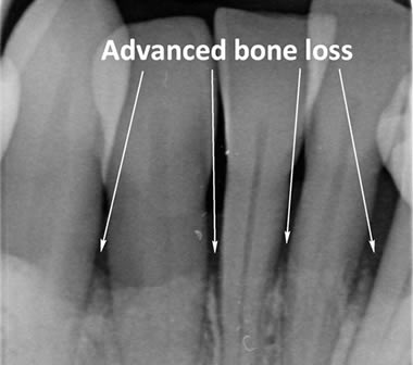Bone loss around lower front teeth