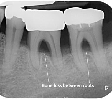 Bone loss between roots of lower back teeth