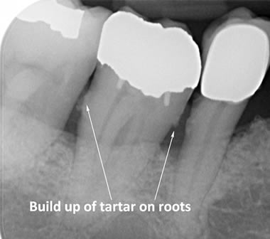 Tartar build up around lower back teeth