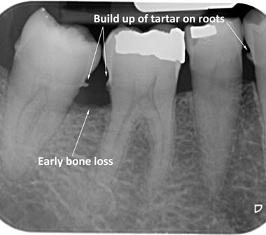 Bone loss and tartar build up around lower back teeth