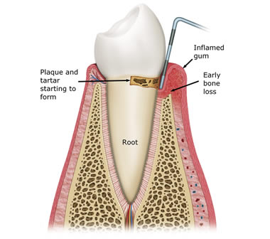 Diagram of early stage periodontitis