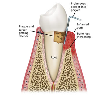 Diagram of moderate periodontitis